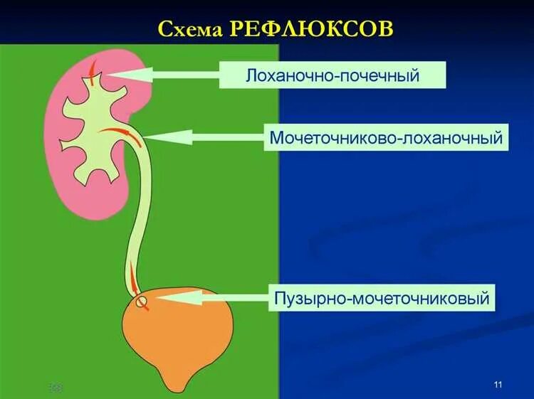 Заброс мочи в почки