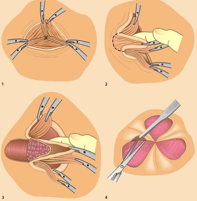 Лигирование узлов латексными кольцами. Склерозирующий укол геморрой. Инфракрасная коагуляция геморроя. Операция миллигана-моргана геморроидэктомия. Хирургические методы геморрой.