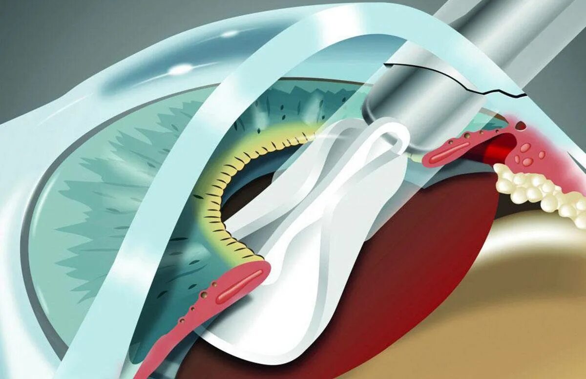 Катаракта факоэмульсификация. Факоэмульсификация с имплантацией ИОЛ. Катаракта имплантация ИОЛ. Факоэмульсификация катаракты с имплантацией интраокулярной линзы. Замена хрусталика что нельзя делать после операции
