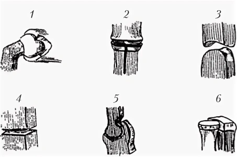 Изменение формы сустава. Формы суставных поверхностей. Двухосный сустав цилиндрический. Оси вращения суставов. Кулястий суглоб.