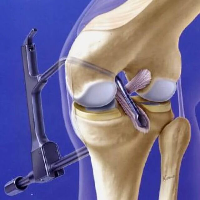 Крестовидная коленная связка. ПКС крестообразной связки коленного. Операция ПКС коленного сустава. Артроскопия коленного сустава разрыв мениска. Артродез коленного сустава.
