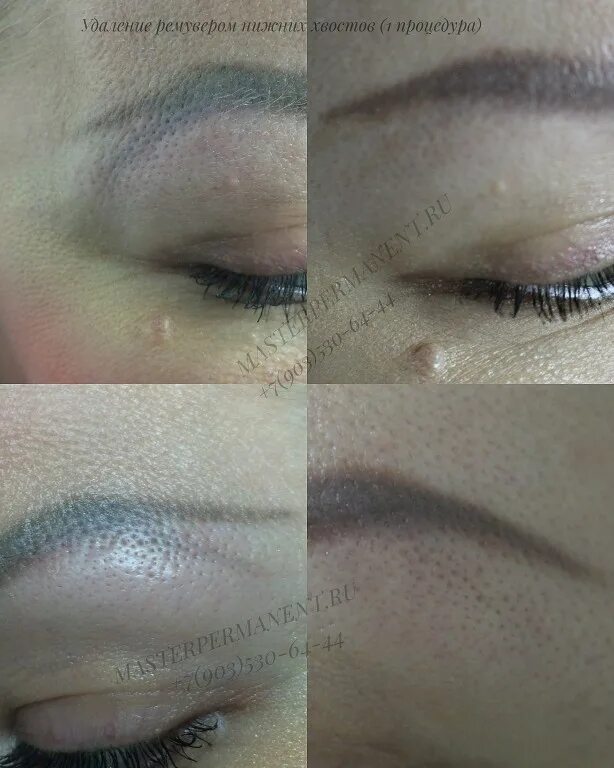 ремувер demicolor. ревайвинг plus. ревайвинг до и после. татуаж под бровями. ревайвинг для удаления татуажа.
