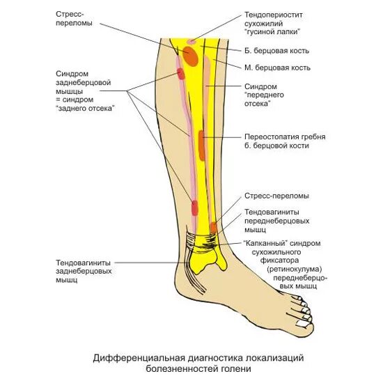 Болит нога икра к какому врачу. Почему болят кости ног ниже колена спереди. Боль берцовой кости в ноге спереди. Почему болят ноги в кости голени спереди. Боль в берцовой кости при ходьбе спереди.