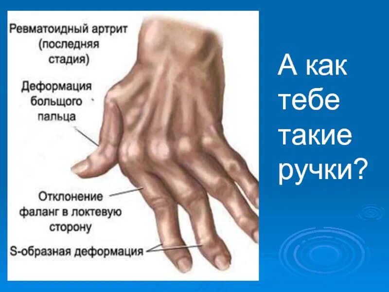 Ревматоидный артрит мышцы. Паукообразная кисть ревматоидный артрит. Степени ревматоидного артрита. Ревматоидный артрит ранняя стадия. Ревматоидный артрит по стадиям.