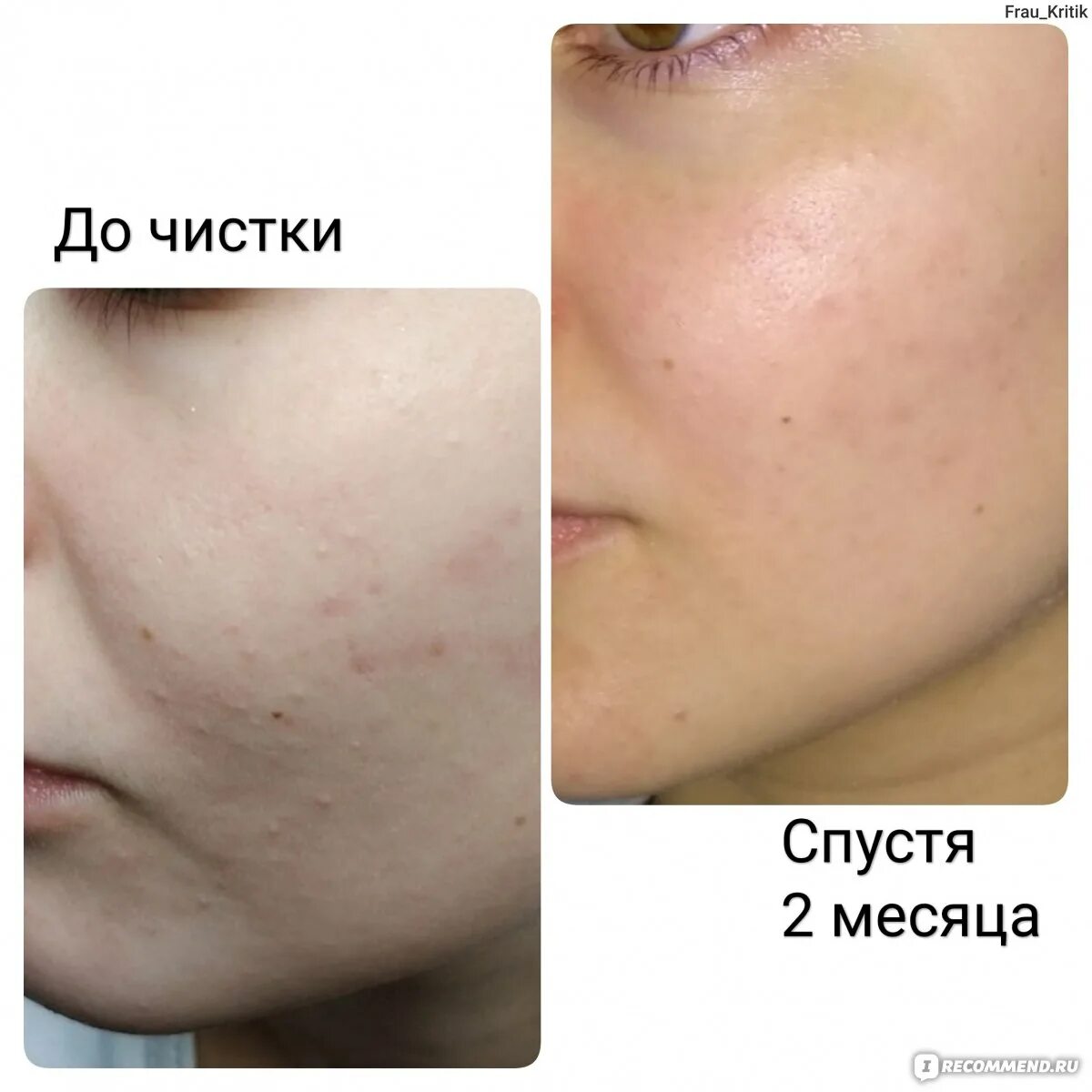 Через сколько после чистки