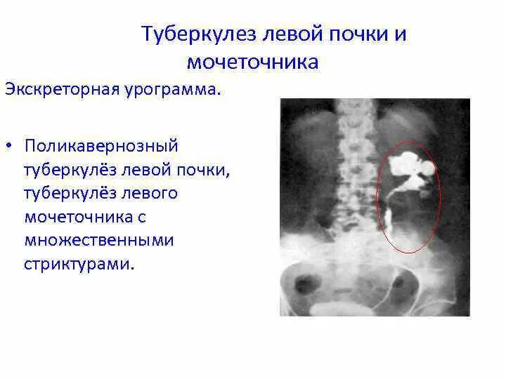 Туберкулез мочевой системы