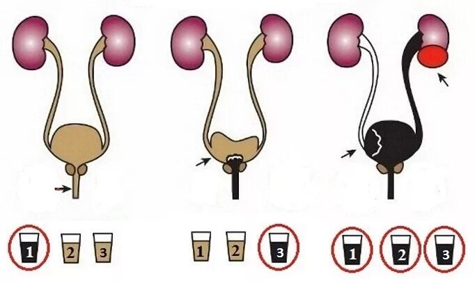 Моча 3-х стаканная проба. Двухстаканная проба мочи ,трехстаканная проба. 3х стаканная проба Томпсона. Проба Томпсона моча. Трехстаканная проба мочи