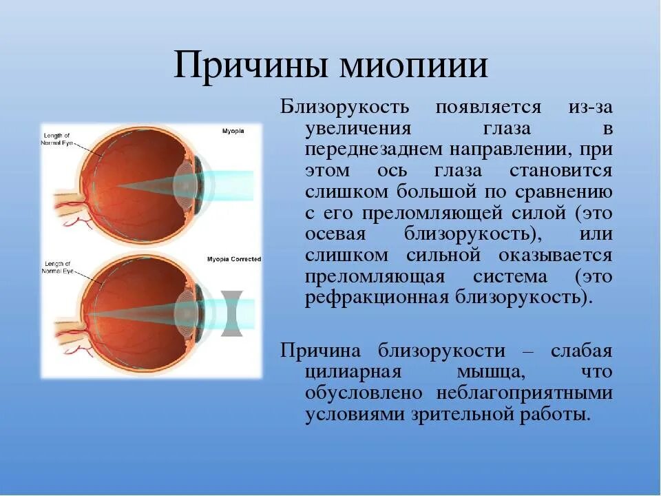 Миша страдает близорукостью а его брат. Миопия -7 степень. Симптомы близорукости биология 8 класс. Миопия из за чего возникает. Причины близорукости.