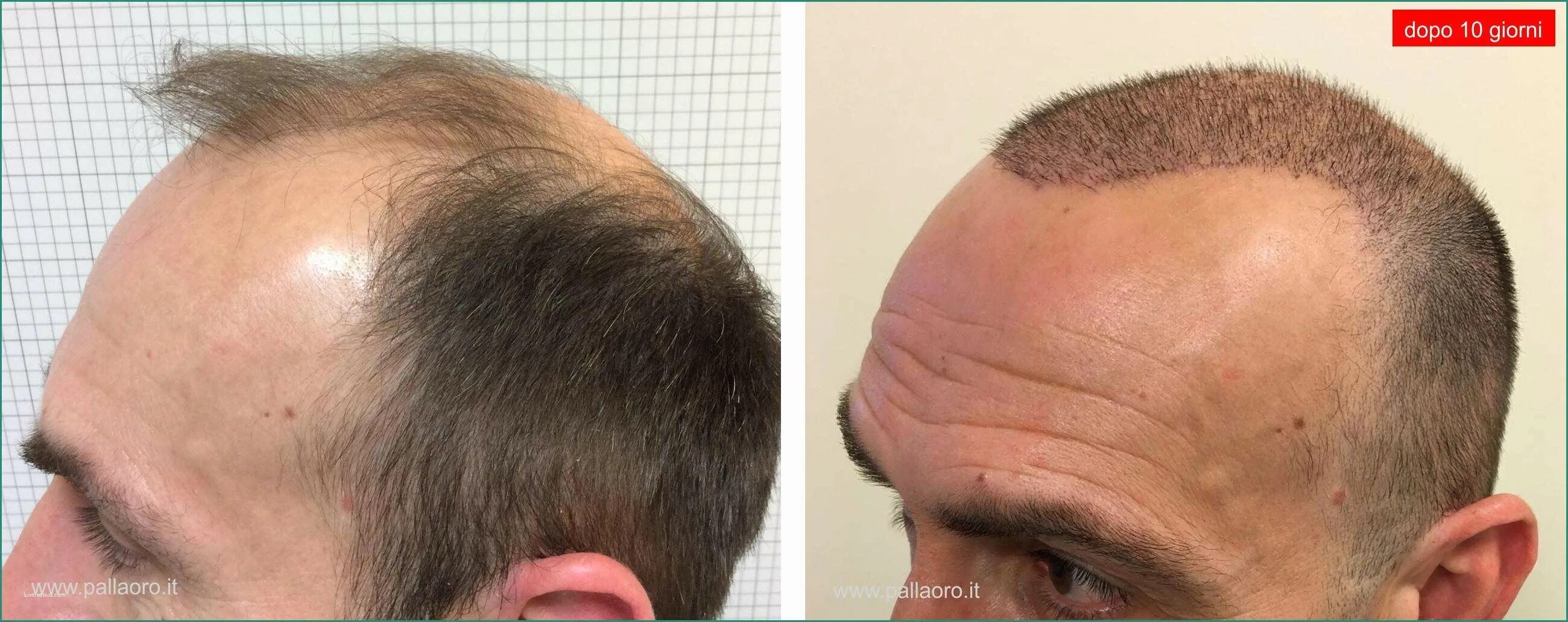 Форум после пересадки. Шрамы от пересадки волос. Трансплантация волос на шрам. Голова после пересадки волос.
