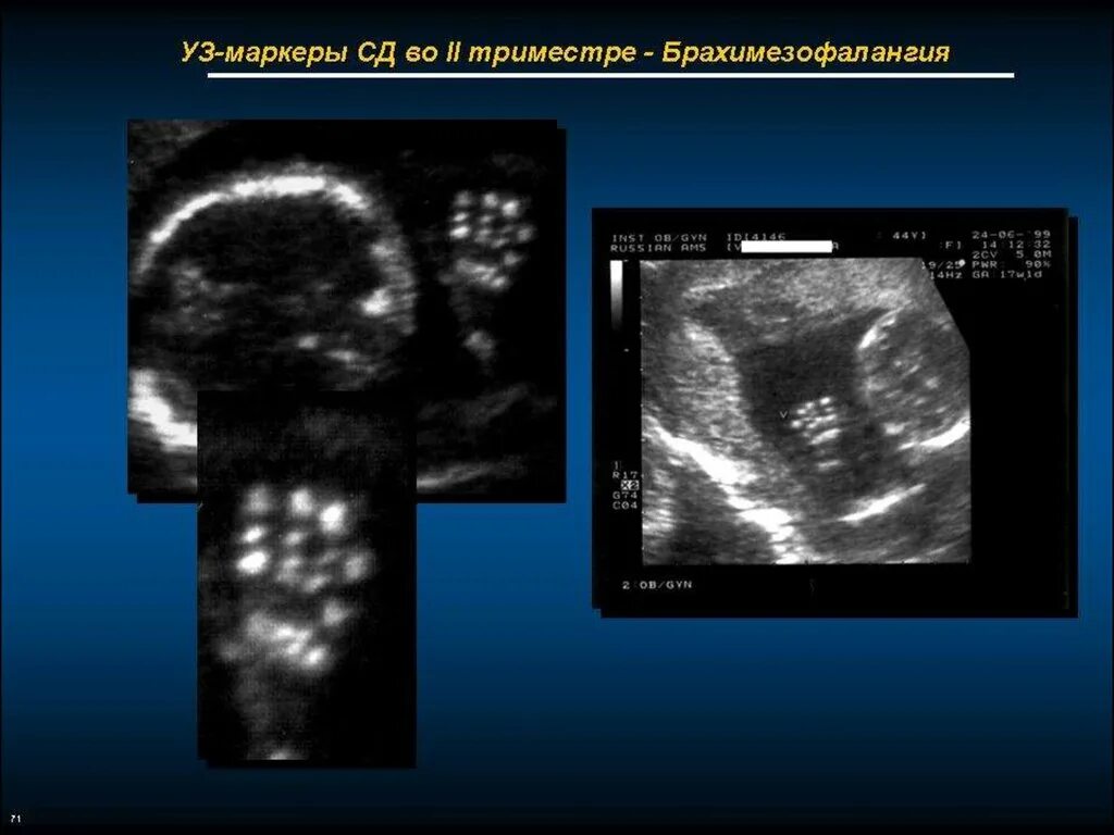 Узи аномалий. Ультразвуковые маркеры хромосомных аномалий плода. УЗИ маркеры хромосомной патологии. УЗИ маркеры патологии плода. Хромосомные аномалии у плода на УЗИ.