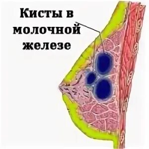 Фиброзно-кистозные изменения молочных желез что это такое. Мастопатия причины возникновения. Симптомы фиброзно-кистозной мастопатии молочной железы. Узловая мастопатия молочной железы что это. Узловая форма фкм молочной железы маммография.