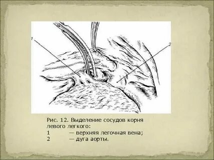 Левый корень