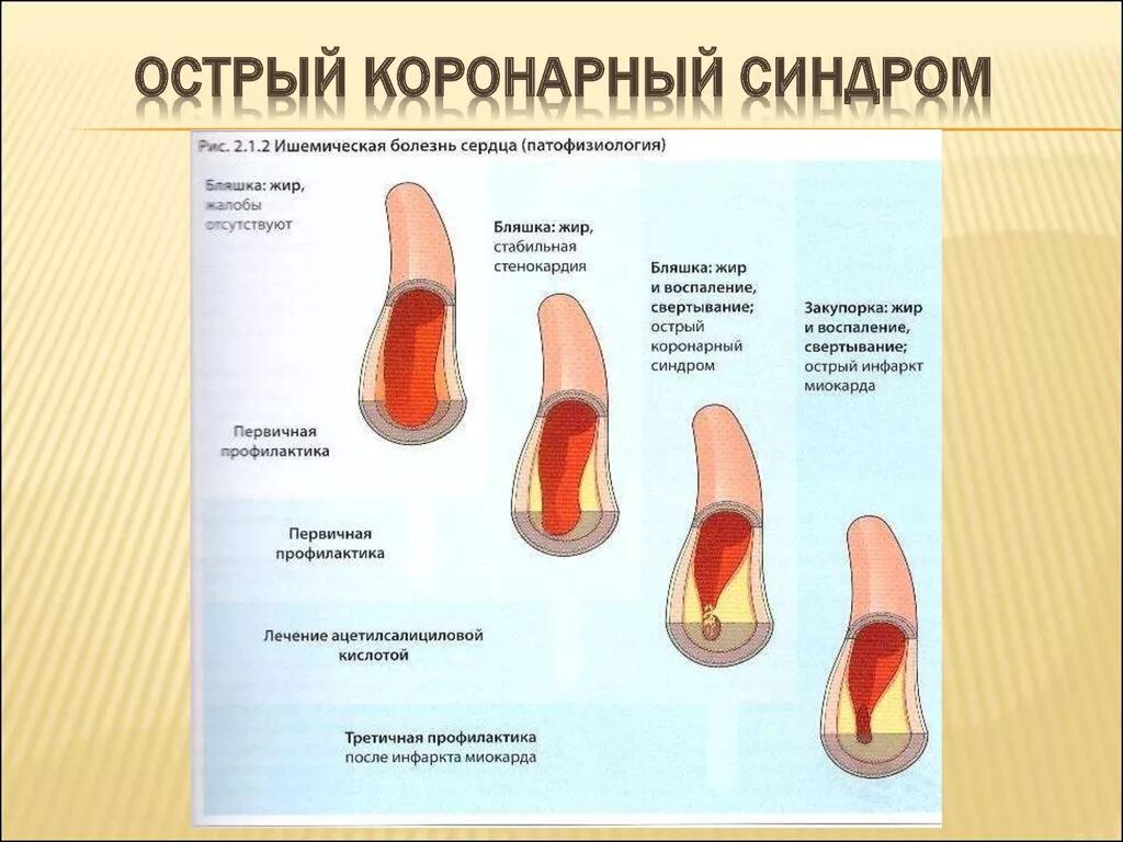 Коронарные осложнения. Острый коронарный синдром. Острый коронарный синдр. Острый коронарный синдром патогенез. Острый коронарный синдром этиология.