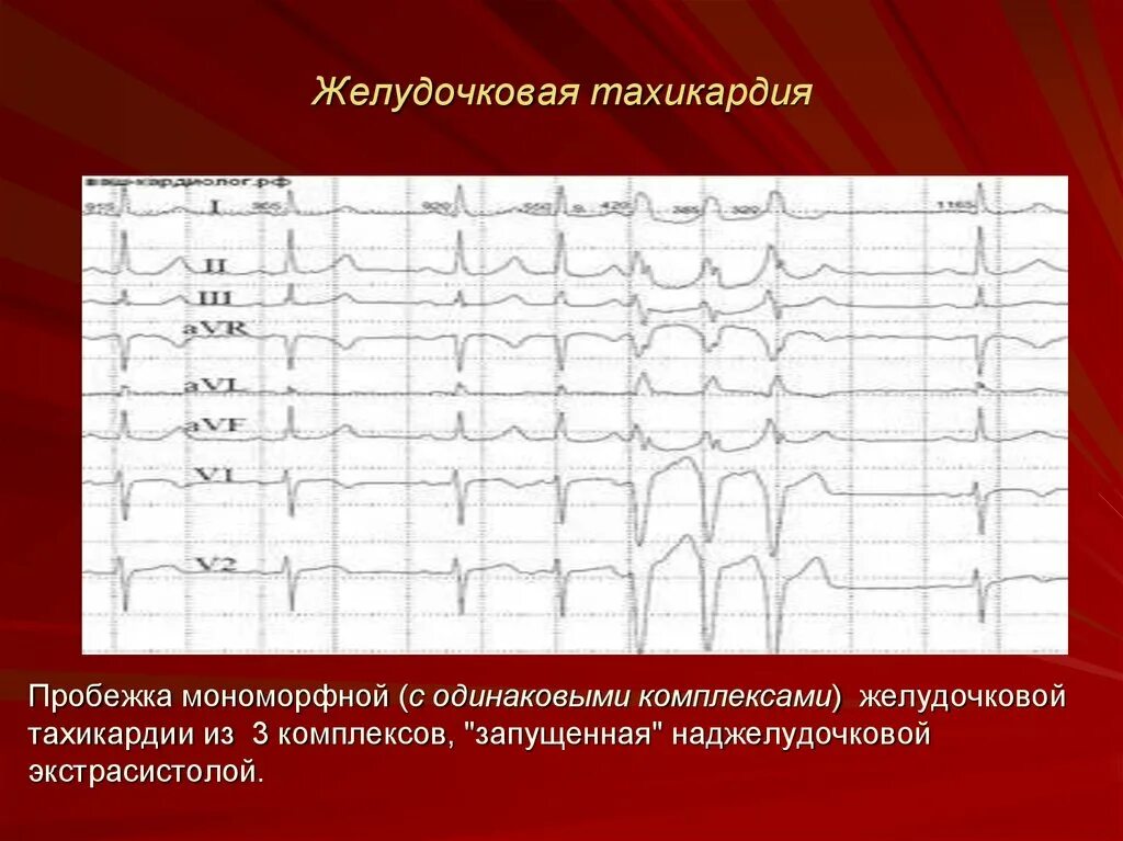 Желудочковая тахикардия на экг. Пробежки желудочковой экстрасистолии. Пробежка желудочковой тахикардии на ЭКГ. Пробежки суправентрикулярной тахикардии на ЭКГ. Пробежка наджелудочковой тахикардии 4 комплексов.