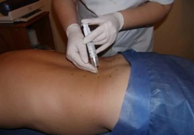 Боль в боку. Колоть в пояснице. Колоть в пояснице. Блокада грыжи позвоночника при грыже. Уколы при болях в позвоночнике.