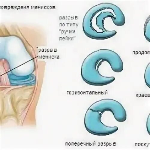 Дегенеративные изменения менисков 1 степени