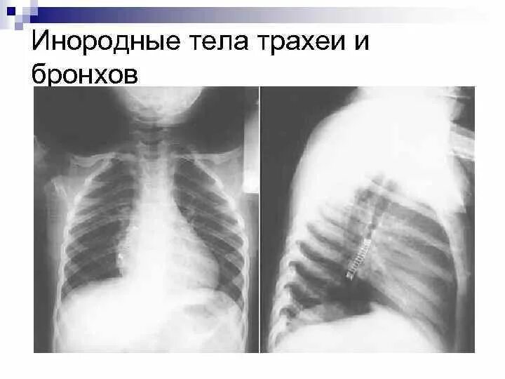 Инородные Тела Трахеи Бронхов