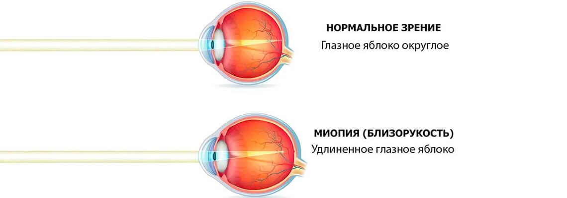 Близорукость. Глазное яблоко при миопии. Миопия глаза что это такое. Близорукий глаз.