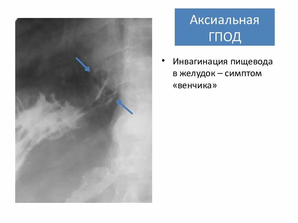 Аксиальная грыжа пищевода рентген. Параэзофагеальная грыжа. Скользящая аксиальная грыжа пищеводного отверстия диафрагмы рентген. Аксиальная кардиальная грыжа пищевого отверстия диафрагмы. Грыжа пищеводного отверстия причины