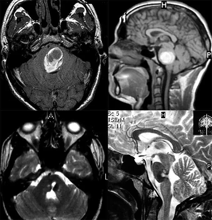 Рак ствола головного мозга. Кавернома ствола мозга. Гематома в стволе головного мозга. Кавернозная ангиома четверохолмия мрт.