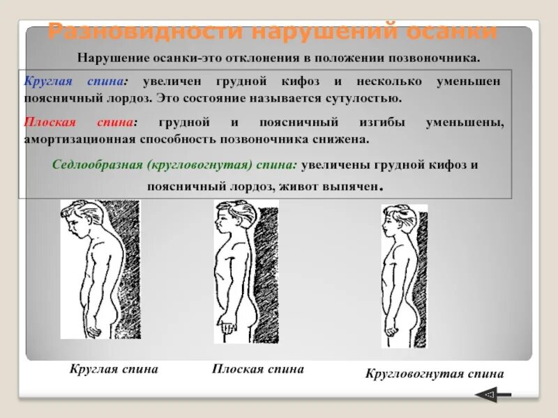 Диагностика нарушения осанки. Виды нарушения осанки. степени нарушения осанки. круглая спина. нарушение осанки круглая спина.