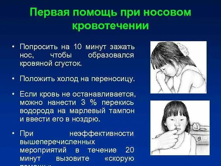 Первая помощь при носовом кровотечении алгоритм. Оказание помощи при кровотечении из носа. носовое кровотечение первая помощь. алгоритм оказания первой помощи при носовом кровотечении. оказание первой медицинской помощи при кровотечении из носа.