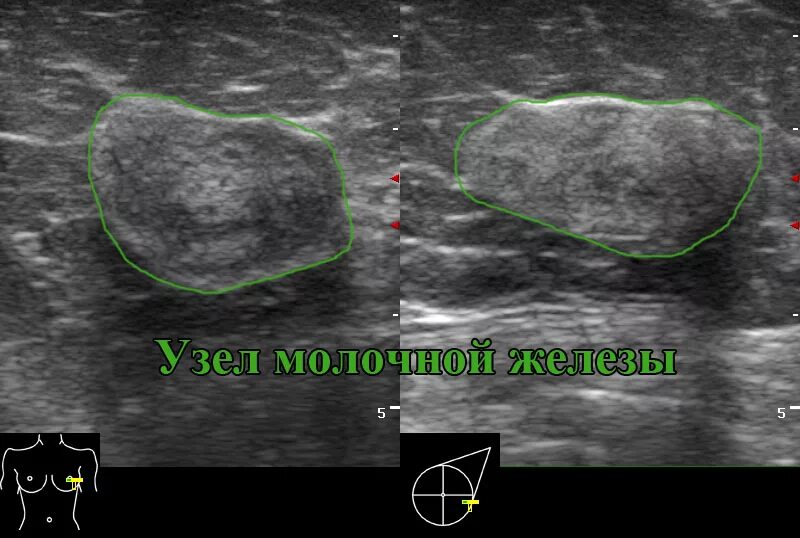Фиброзная мастопатия молочной железы на УЗИ. Интрамаммарный лимфатический узел УЗИ. Образования молочных желез на УЗИ. Здоровая молочная железа на УЗИ.