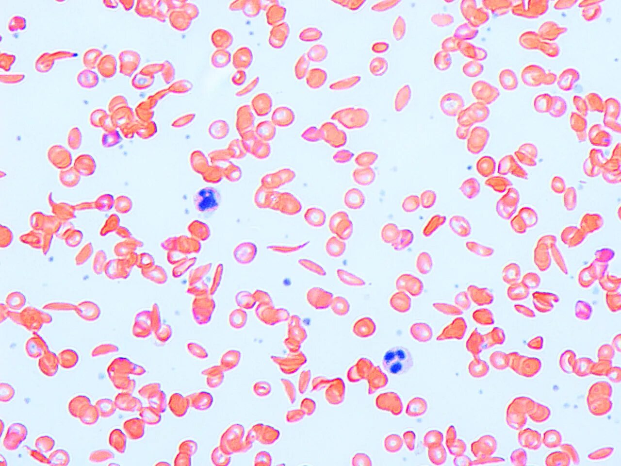 Эритроциты при серповидно клеточной анемии. Микроскопе серповидноклеточная анемия. Серповидноклеточная анемия мазок крови. Серповидноклеточная анемия мазок. Эритроциты на белом фоне.