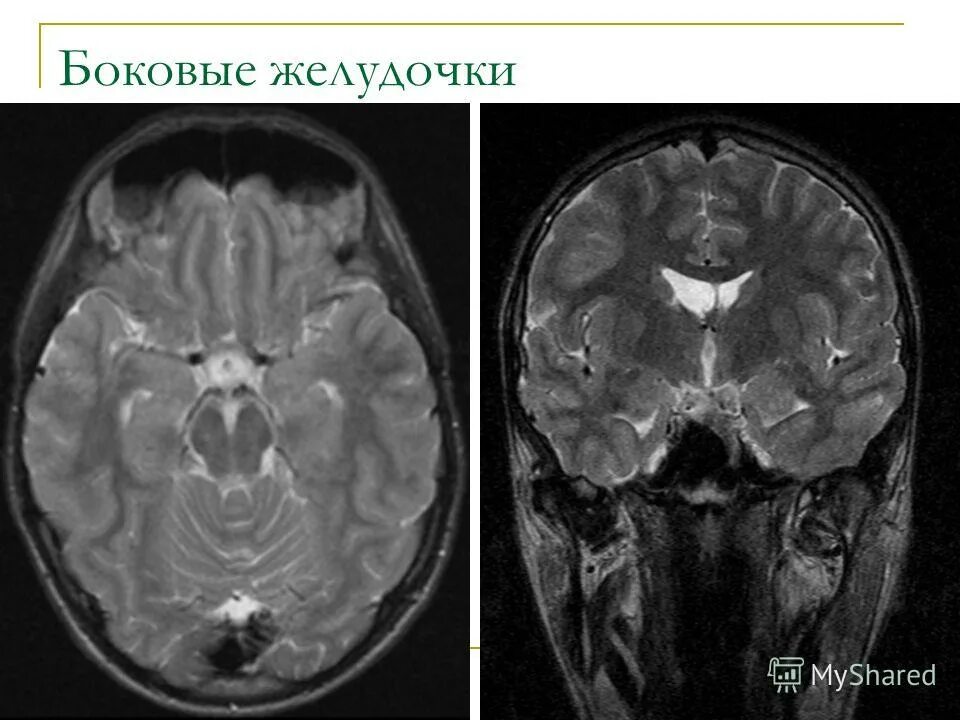 Расширение желудочков головного мозга на кт. Асимметрия желудочков на кт. Асимметрия боковых желудочков мрт. Резидуальная энцефалопатия мрт. Мрт асимметрии мозга.