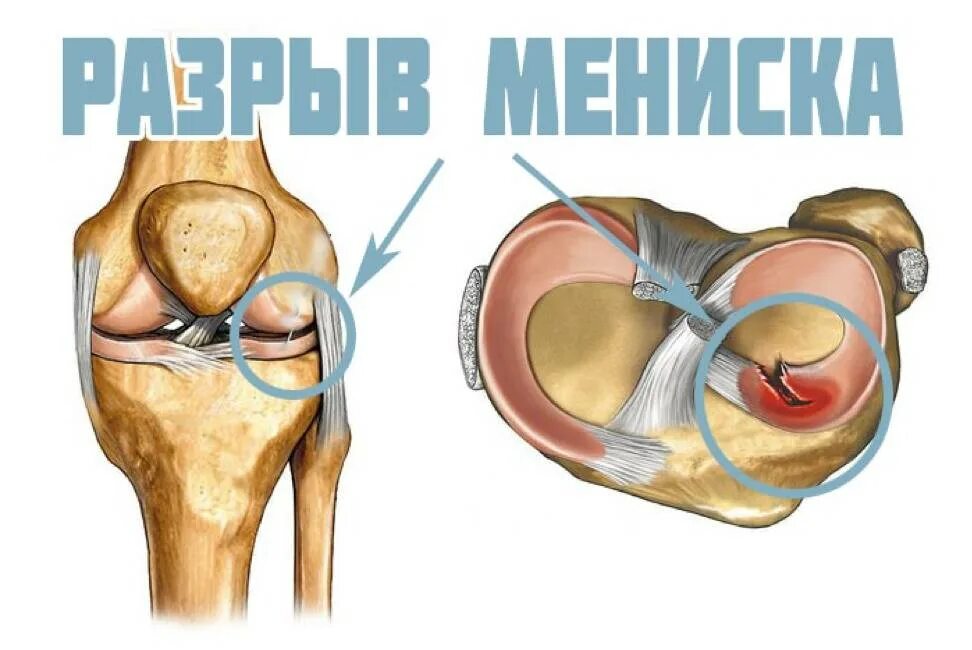 Лечение разрыва мениска коленного. Разрыв мениска коленного. Разрыв мениска коленного сустава 3 а. Повреждён мениск коленного сустава симптомы. Разрыв рога мениска коленного сустава.