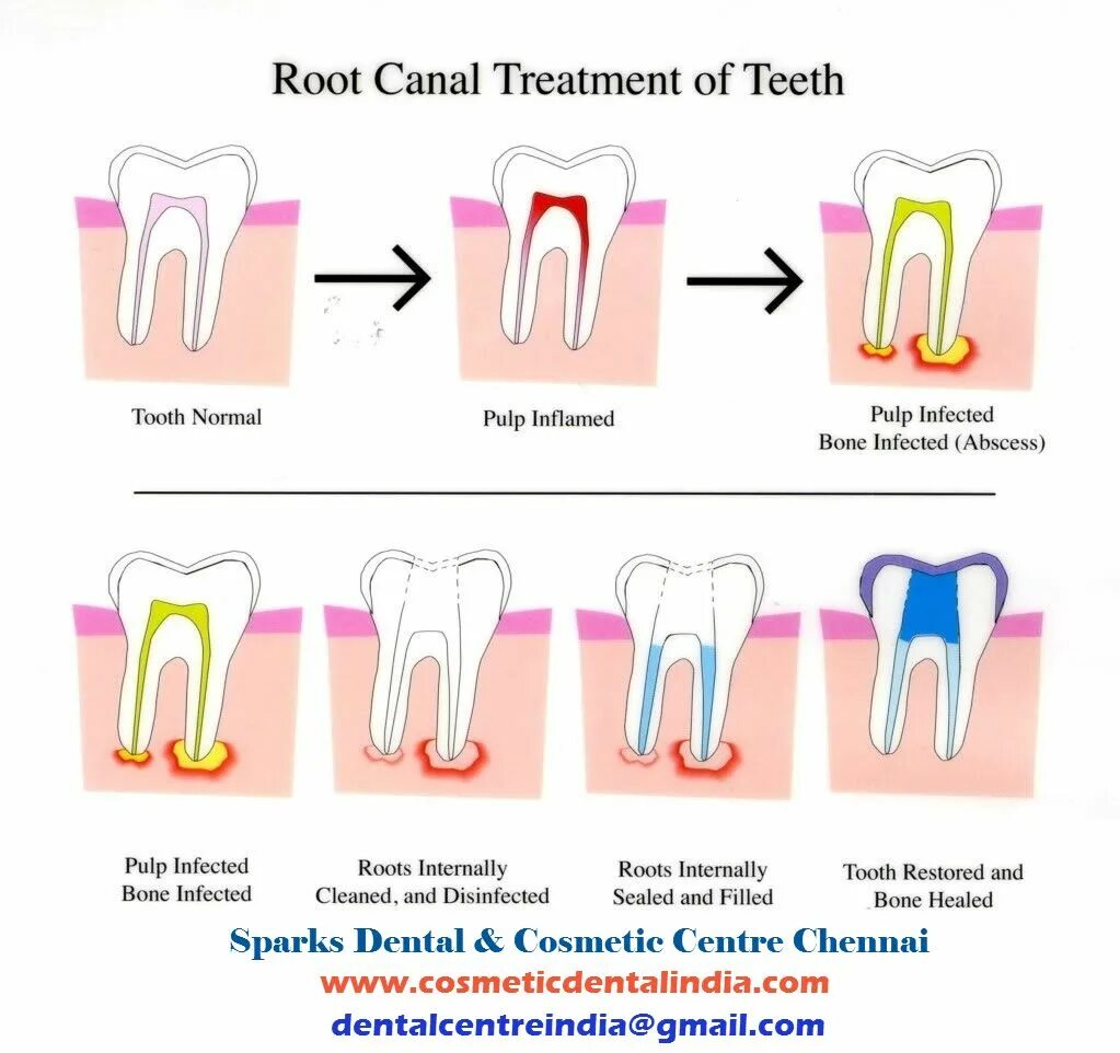 Root canal