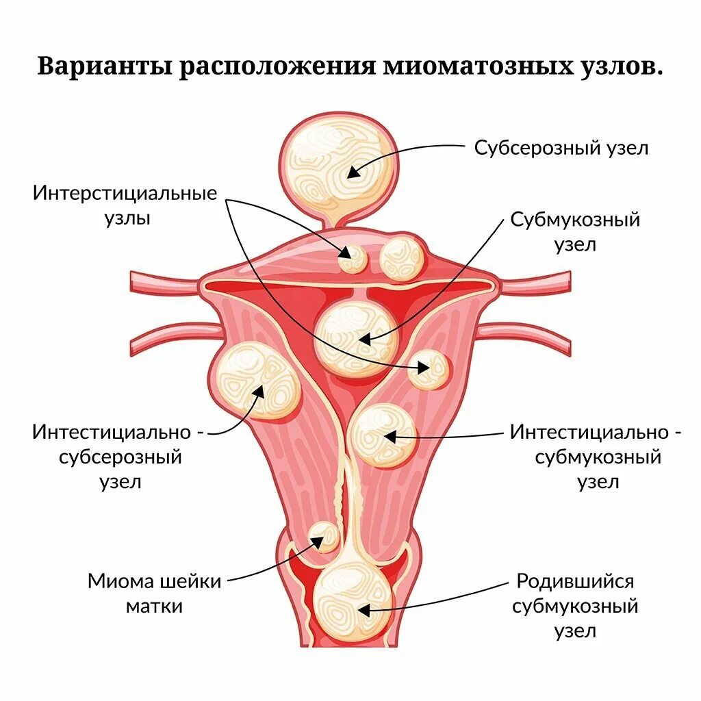 Миома матки симптомы и признаки