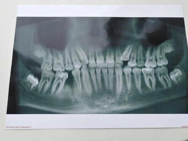 Корни зуба мудрости на рентгене. Рентген зубов зуб мудрости. Зуб 8 корень