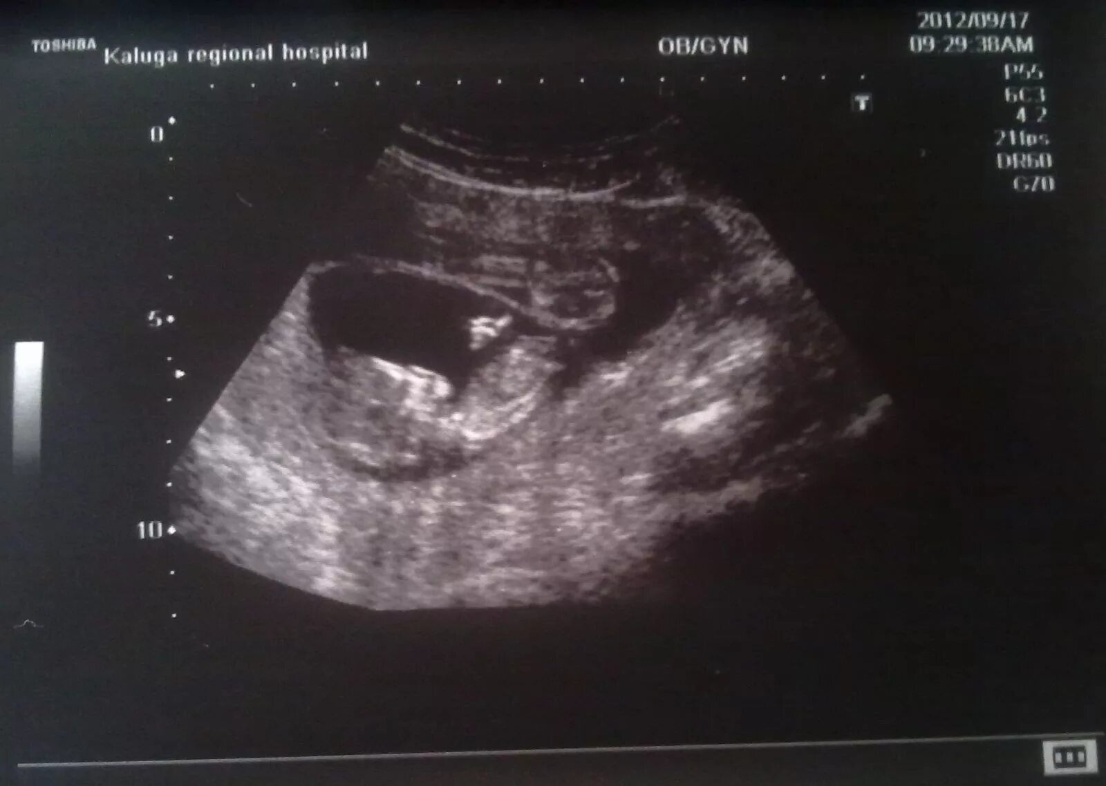 Узи двойни на 12 неделе. Монохориальная двойня узи. Узи 12 недель беременности двойня. Фото узи 12 недель двойня. Узи двойни на 12 неделе.