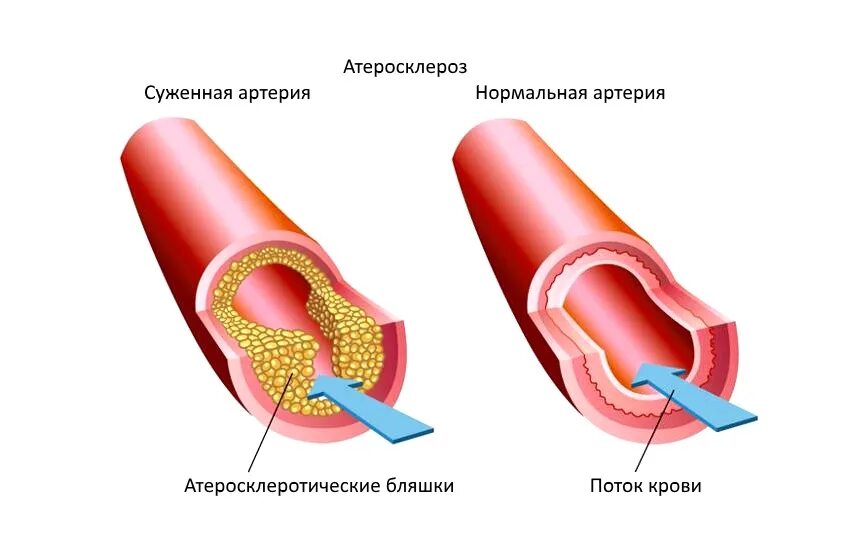 Разрыв кровеносного сосуда. Стадии атеросклероза коронарных артерий. Атеросклероз фиброзные бляшки. Стадии образования Блашка атеросклероз. Схема образования атеросклеротической бляшки.