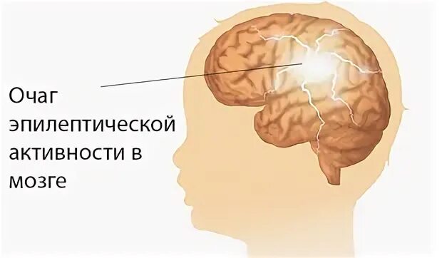 Очаг в мозгах