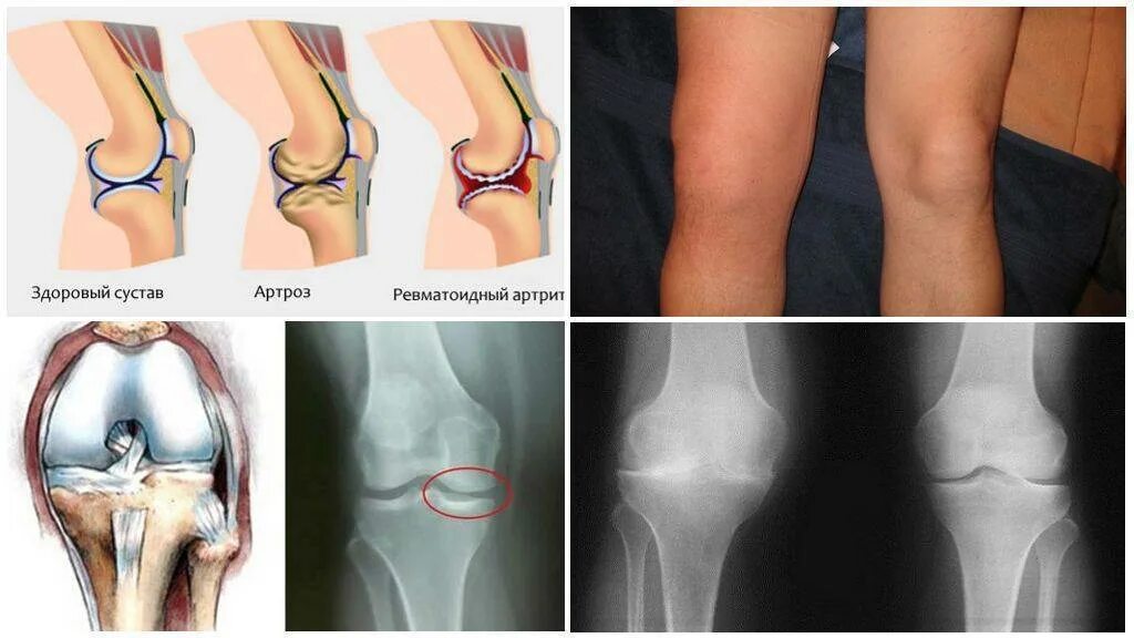 Ювенильный артрит коленного сустава рентген. Остеоартроз скакательного сустава. Артропатия коленных суставов. Полиартрит коленного сустава.