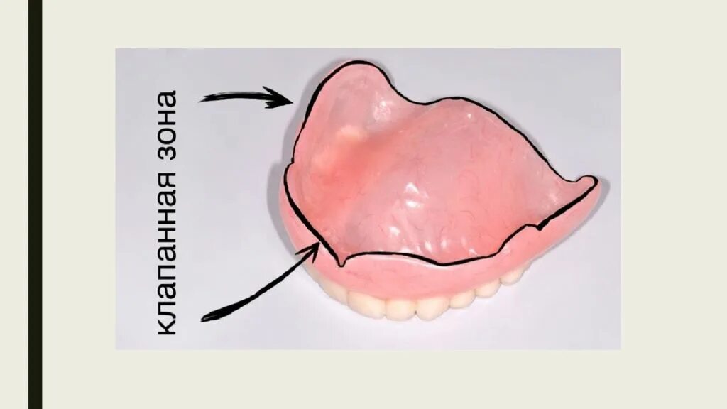 Границы пластиночного протеза. Границы полного съемного протеза. Протез на верхнюю челюсть при полном отсутствии зубов. Границы съемного протеза на верхней челюсти. Границы базиса полного съемного протеза.