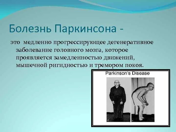 Болезнь паркинсона. Болезнь паркинсона причины возникновения. Движение глаз при болезни паркинсона. Поза просителя при болезни паркинсона. Болезнь паркинсона тремор.
