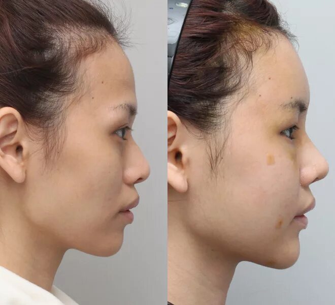 Rhinoplasty for a Short Nose - All You Need to Know! - Центр Пластической Хирург