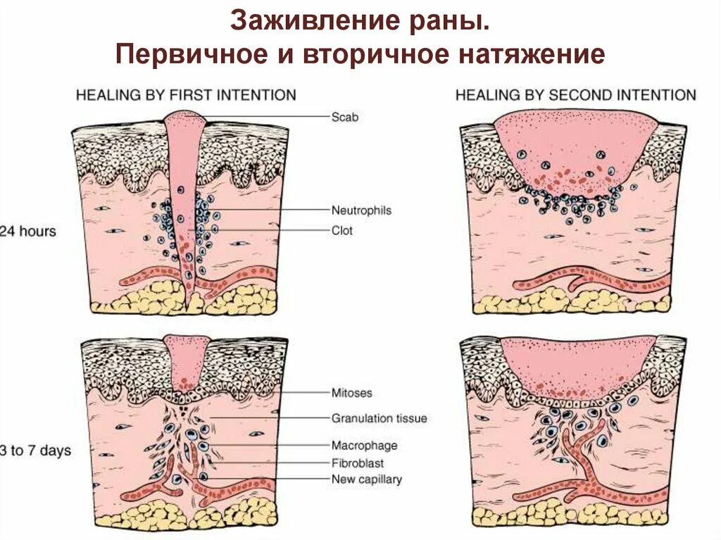 Сколько заживает глубокий. Заживление РАН первичным натяжением. Первичное и вторичное натяжение заживление РАН. Заживление РАН вторичным натяжением. Заживление РАН первичным и вторичным натяжением патанатомия.