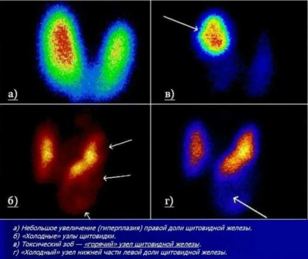 Токсическая аденома щитовидной железы сцинтиграфия. Радионуклидные методы исследования щитовидной железы. Холодный узел щитовидной железы сцинтиграфия. Сцинтиграфия щитовидки гипертиреоз.