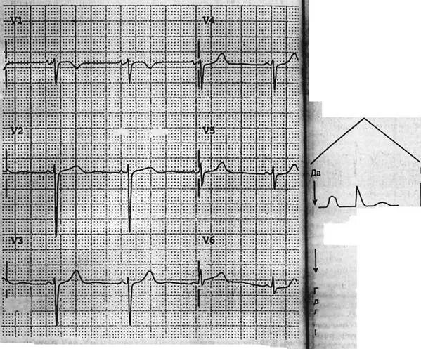 Отрицательный зубец р на ЭКГ В v1. Нарастание зубца r в v1-v6. Отрицательный зубец т в v1-v6. На ЭКГ нет зубца r в v1-v3.