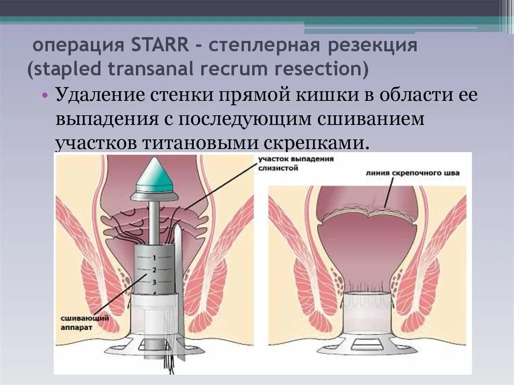 Сколько длится операция по удалению прямой кишки. Операция лонго при ректоцеле. операция делорма при выпадении прямой кишки. рактацели. операция на ректоцеле прямой кишки.
