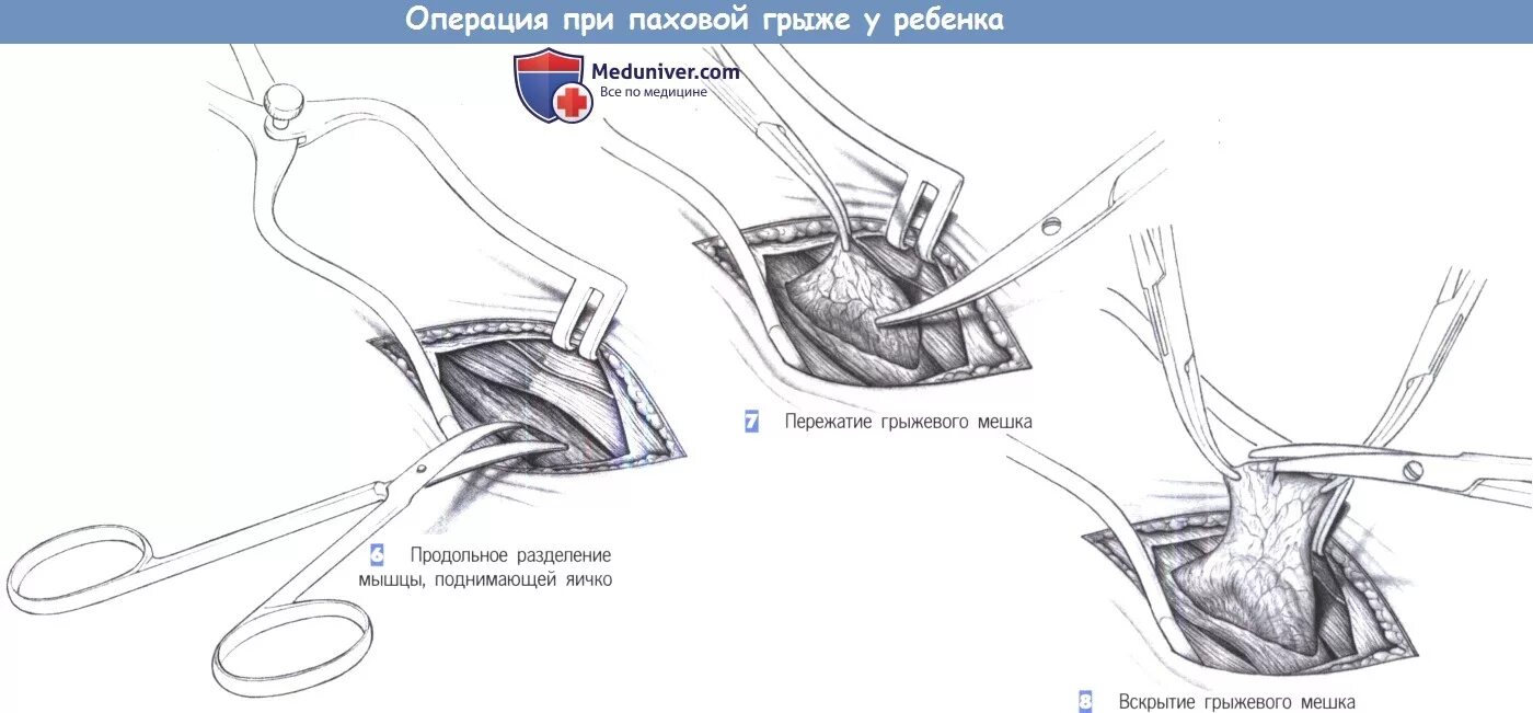 Паховая грыжа лапароскопически. Операция ребенку 2 года паховая грыжа. Пахово мошоночная грыжа операция. Паховые грыжи методы операций. Паховая грыжа методы лечения