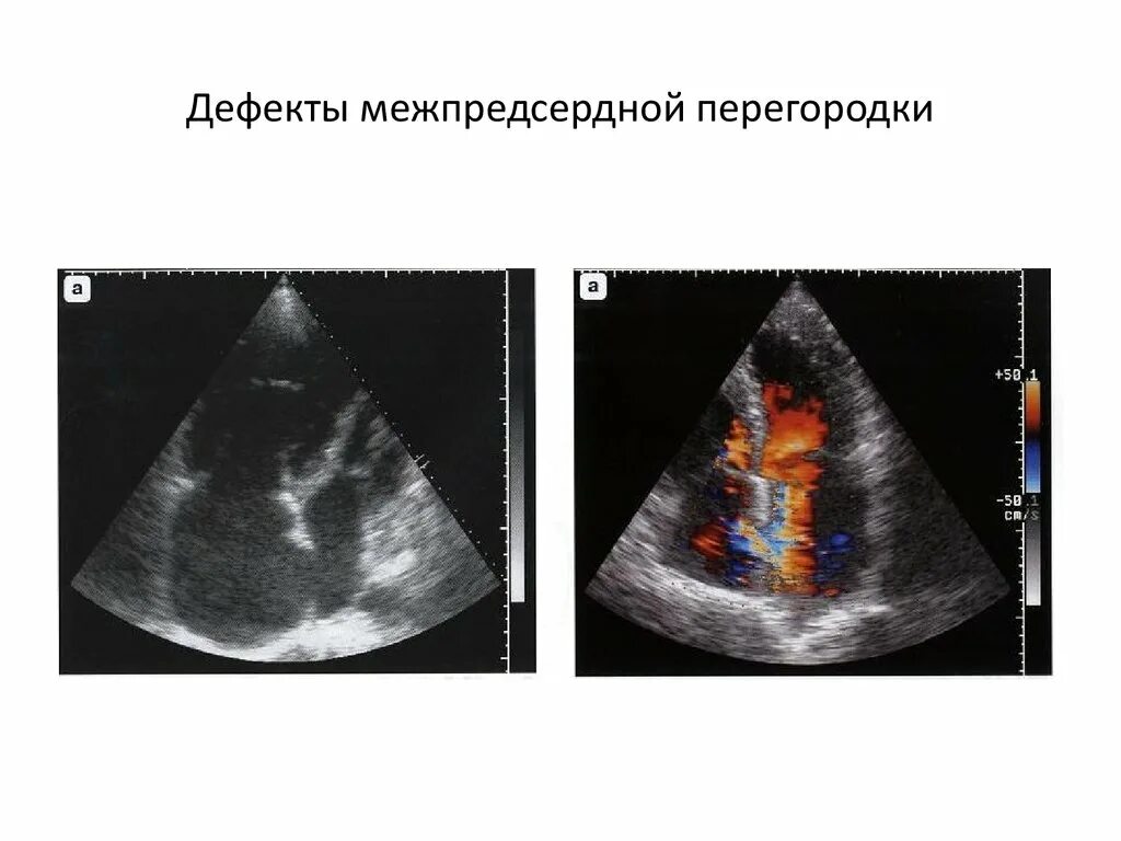 Аневризма мпп r тип