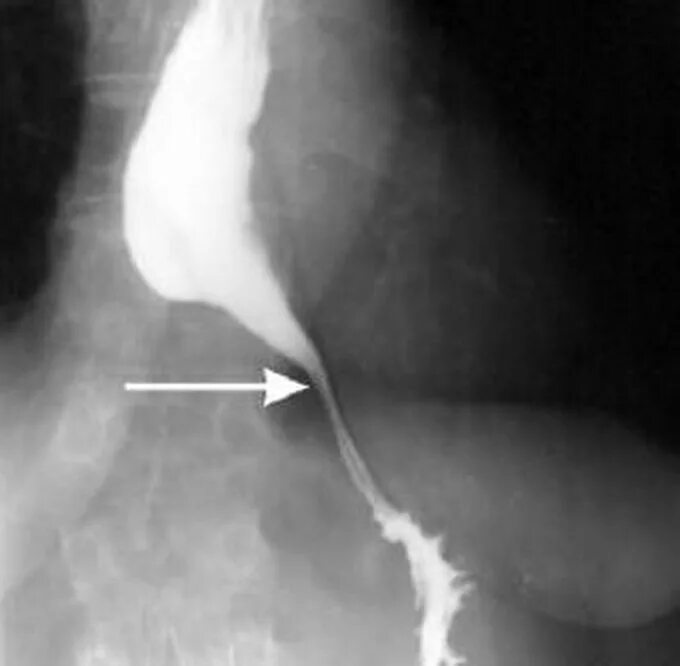 Пищевода 1 степени. Ахалазия кардии пищевода. Ахалазия кардии рентген. Ахалазия кардии пищевода рентген. Кардиоспазм и ахалазия пищевода рентген.