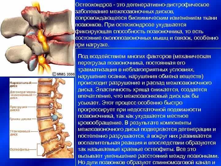 Дистрофические изменения позвоночника. Дистрофические изменения межпозвонковых дисков шейного отдела. Дегенеративно-дистрофические изменения l2 l3. Ддзп поясничный остеохондроз. Остеохондроза дисков пояснично-крестцового отдела.