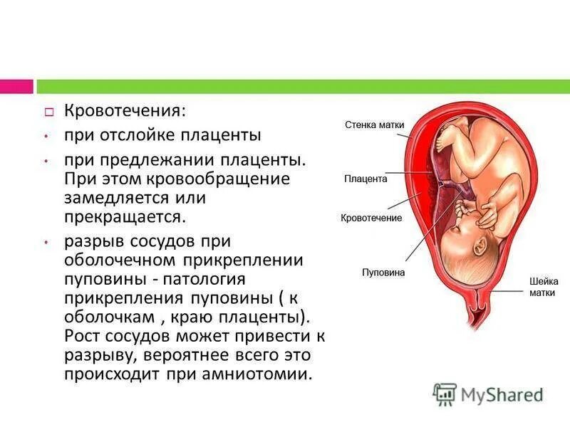 При низкой плацентации можно. Отслойка плаценты патанатомия. Кровотечение при отслойке плаценты. Центральная отслойка плаценты. Отслойка предлежащей плаценты.