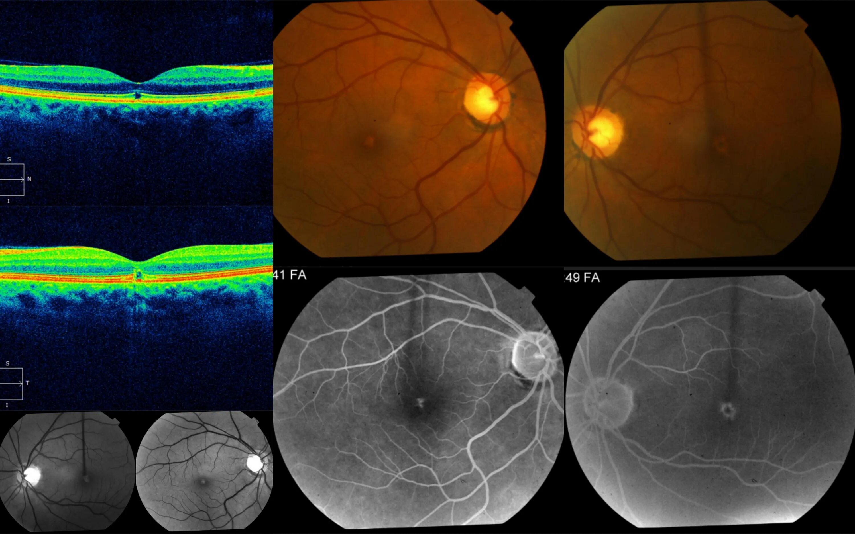 Солнечная ретинопатия. Солнечная ретинопатия окт. Миопическая макулопатия. Макулопатия глаза